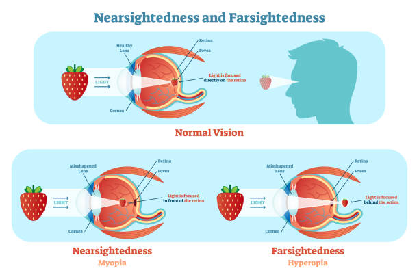 Far Sightedness and Near Sightedness