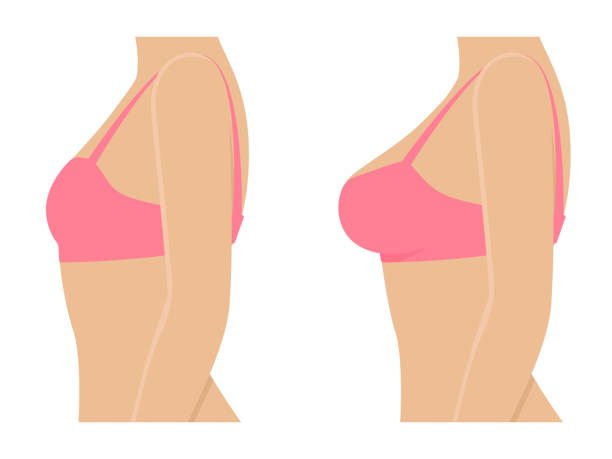 Female breasts in bra before after augmentation Female breasts in bra before and after augmentation. Woman before and after breast size correction. Plastic surgery concept. Vector illustration isolated on white background, side view profile. silicone stock illustrations
