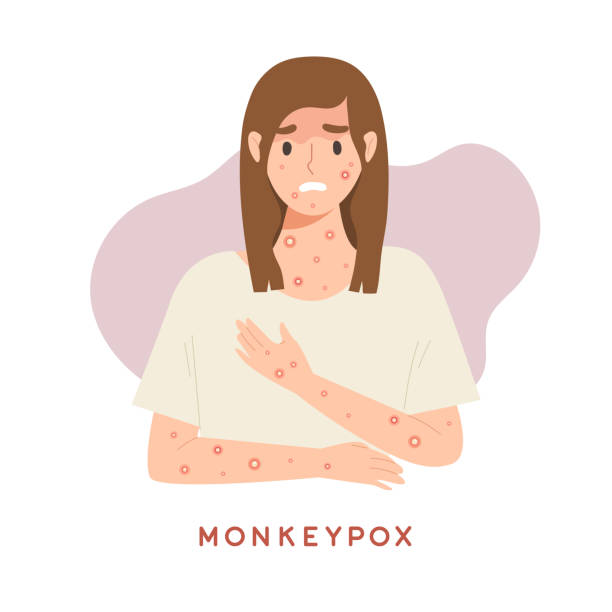 female with rash skin one of monkeypox symptom. concept of monkeypox virus pandemic, health care and medicine, sickness, fever. - 痘類病毒 幅插畫檔、美工圖案、卡通及圖標