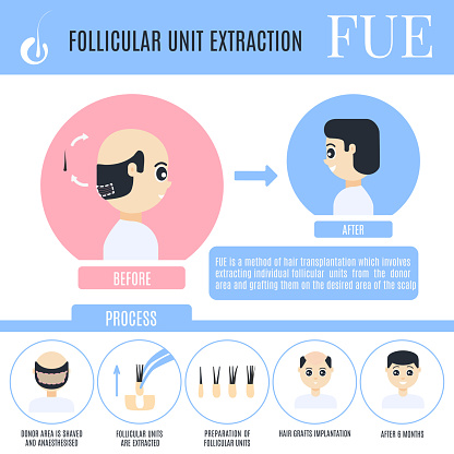 Follicular Unit Extraction Infographics For Male Alopecia Stock ...