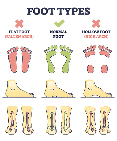 Foot Types With Flat Normal And Hollow Feet Comparison In Outline ...