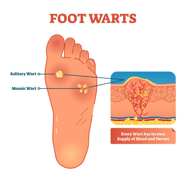 foot wart how to tell)