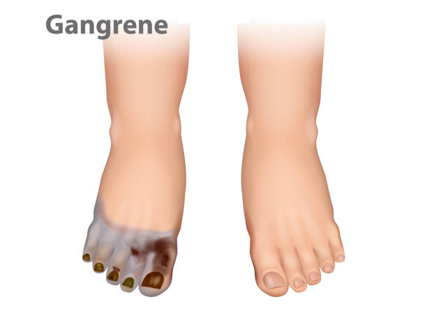 82 gangrene foot stock photos pictures royalty free images istock