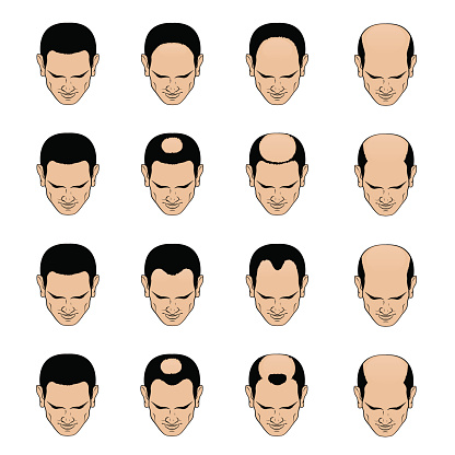 Hairl loss patterns and stages for men
