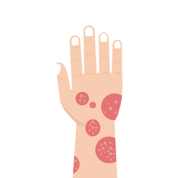 ilustraciones, imágenes clip art, dibujos animados e iconos de stock de mano con la psoriasis o el eczema. ilustración de vector. - enfermedad de la piel