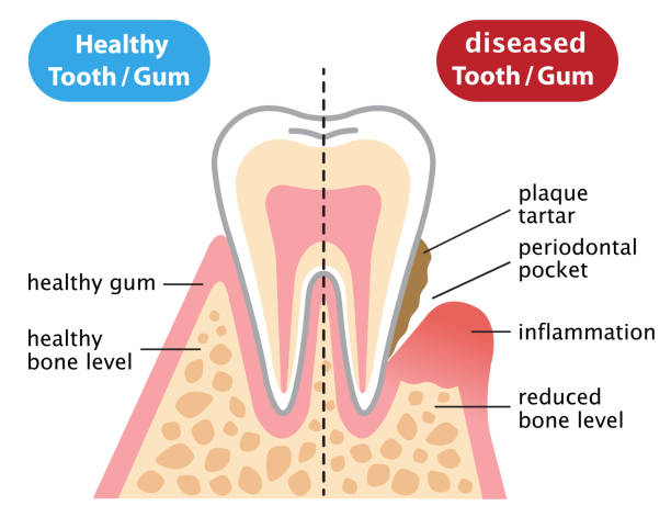 Gum Disease Tooth