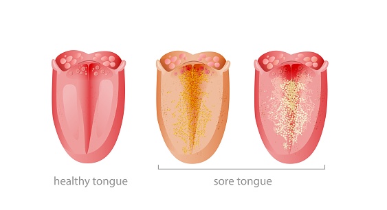Healthy and sick tongue. Pink pure organ and affected yellow infectious plaque and fungus bacterial.