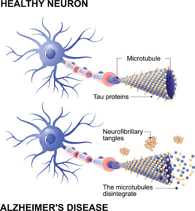 healthy cell and neurons with Alzheimer's disease. Tau hypothesis