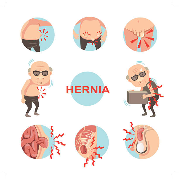 Hernia Diagram of inside  umbilical and inguinal hernia, Men with hernia symptoms and signs that can be noticed.Cartoon vector illustration hernia inguinal stock illustrations