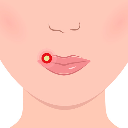Herpes On Lips Cold Sore Stock Illustration Download Image Now