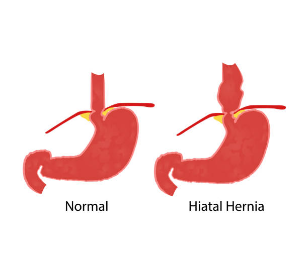 Hiatal hernia and normal anatomy of the stomach and esophagus Hiatal hernia and normal anatomy of the stomach and esophagus vector illustration hernia inguinal stock illustrations