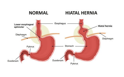 Hernia Hiatal Dan Anatomi Normal Lambung Ilustrasi Stok - Unduh Gambar  Sekarang - iStock