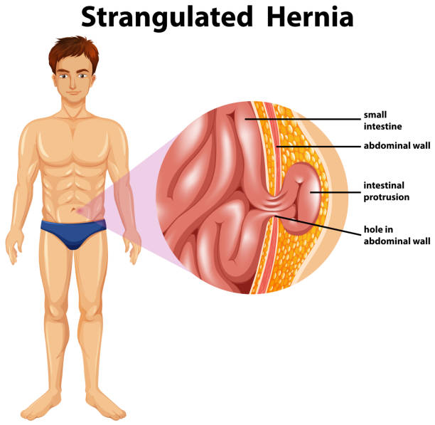 Human Anatomy of Strangulated Hernia Human Anatomy of Strangulated Hernia illustration hernia inguinal stock illustrations