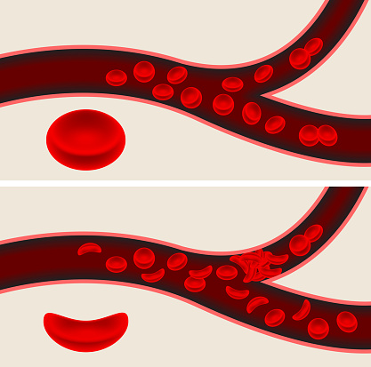 human blood cells and sickle cell anemia blood flow veins