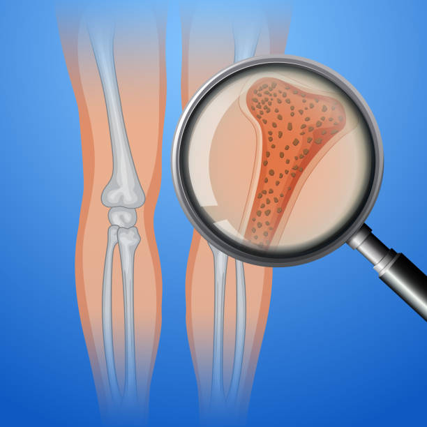 Human bone with osteoporosis vector art illustration