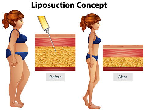 Human Liposuction Concept Diagram Stock Illustration - Download Image Now -  iStock