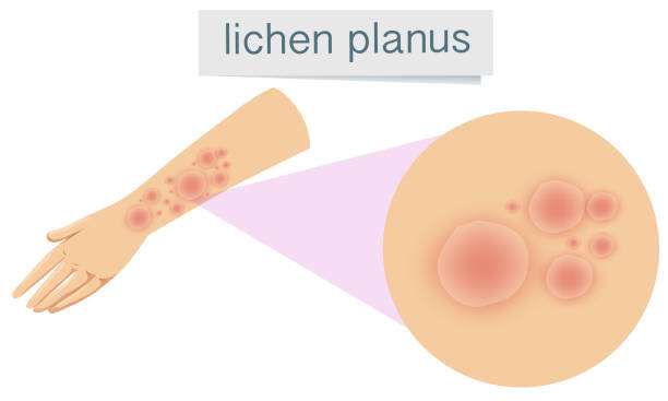 Human Skin with Lichen Planus Human Skin with Lichen Planus illustration Lichen planus stock illustrations
