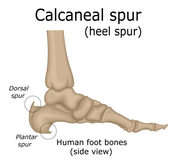 Illustration of Calcaneal spur Illustration of the heel spur, which is a calcium deposit that promotes the appearance of a bone protrusion on the heel plantar fasciitis stock illustrations