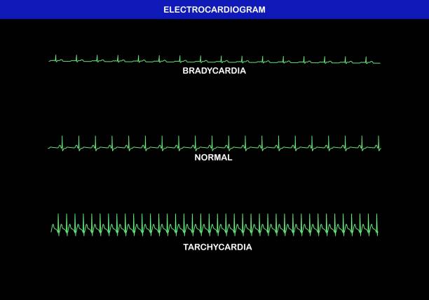 Illustration of different heart rate on electrocardiogram. vector art illustration