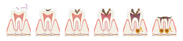 Tooth Pulp - When a tooth's nerve tissue or pulp is damaged, it breaks down and bacteria begin to multiply within the pulp chamber. The bacteria and other decayed debris can cause an infection or abscessed tooth. An abscess is a pus-filled pocket that forms at the end of the roots of the tooth. An abscess occurs when the infection spreads all the way past the ends of the roots of the tooth. In addition to an abscess, an infection in the root canal of a tooth can cause:    EMBED ASSET OVERRIDE   Swelling that may spread to other areas of the face, neck, or head  Bone loss around the tip of the root      Drainage problems extend outward from the root. A hole can occur through the side of the tooth with drainage into the gums or through the cheek with drainage into the skin.  Once the tissues inside the pulp chamber and canals of the tooth suffer irreversible damage or are violated by exposure from trauma or caries (Decay) they will undergo degradation and eventually this dying or dead tissue will become infected and release gases and other chemicals that will eventually escape past the inside of the tooth into the surrounding bone. This will cause pain and often not only causes local bone destruction but can spread the infection to other parts of the body. By completely cleaning out, filling, and sealing off the canals of the tooth, enables the body's defense mechanism and recuperative powers to heal this area and thus prevent, If successful, Any future problem. In this mannger, the tooth can be saved rather than having to remove or extract. 