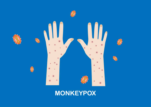 Illustration of rashes on hands and monkeypox viruses Illustration of skin lesions or rashes on patient hands and monkeypox viruses monkeypox stock illustrations