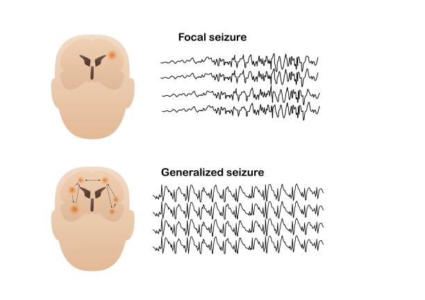 Illustration of seizure types demonstrating by onset and brain waves vector art illustration