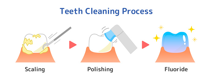 Illustration of tooth cleaning method :PMTC