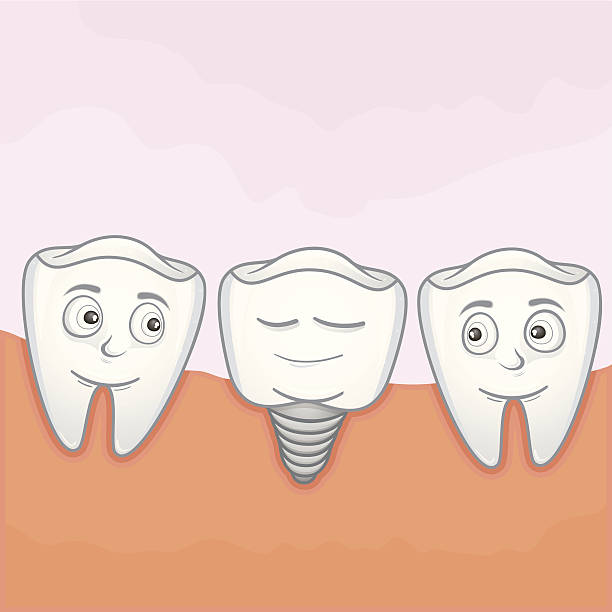 Masa Penyembuhan Implan Gigi- Global Estetik Dental Care
