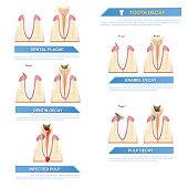 infographic dental caries, stages of tooth decay