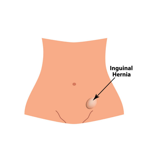 Inguinal hernia. intestinal hernia. Infographics. Vector illustration on isolated background. Inguinal hernia. intestinal hernia. Infographics. Vector illustration on isolated background hernia inguinal stock illustrations