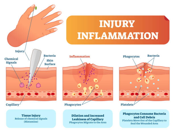 Injury inflammation biological human body response vector illustration scheme. Skin surface injury cross section poster with capillary, phagocytes and platelets. Injury inflammation biological human body response vector illustration scheme. Skin surface injury cross section poster with capillary, phagocytes and platelets fighting bacteria and healing wound. inflammation stock illustrations