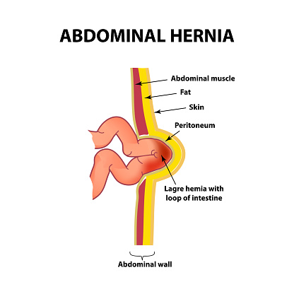 Intestinal hernia. Infographics. Vector illustration on isolated background.