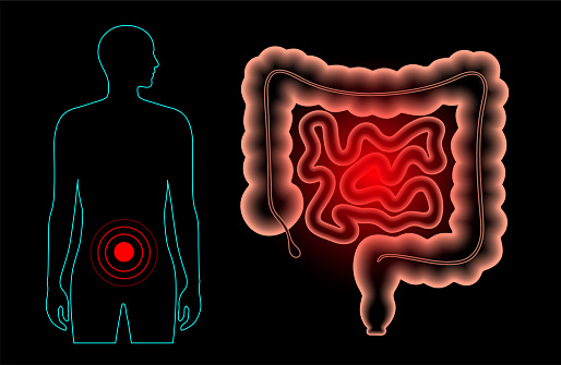 Inflammation and pain in the human intestine. Inflammatory bowel disease, ulcerative colitis, gastrointestinal infections or colorectal cancer. MEdical exam of internal organs 3D vector illustration