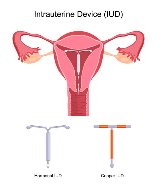 Intrauterine Device IUD Intrauterine device. Contraceptives method, IUD types. Birth control. Vector illustration flat design iud stock illustrations