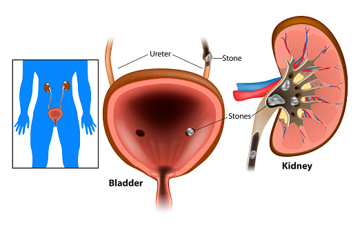 Prosztata egészség. Prostatitis vagy urolithiasis