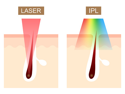 Laser and IPL(Intense Pulsed Light) hair removal differences.  skin care concept