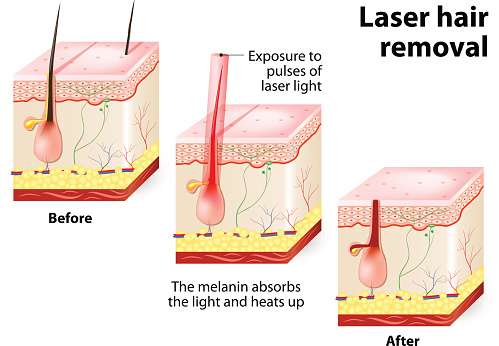 Laser hair removal. Vector diagram