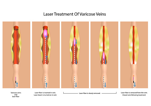 varicose veins treatment)