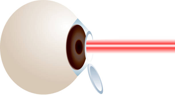 lasik surgery on the eye close-up of a lasik eye surgery. eye doctor stock illustrations