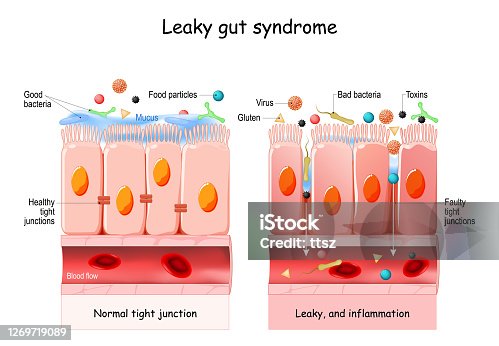 istock Leaky gut Syndrome 1269719089