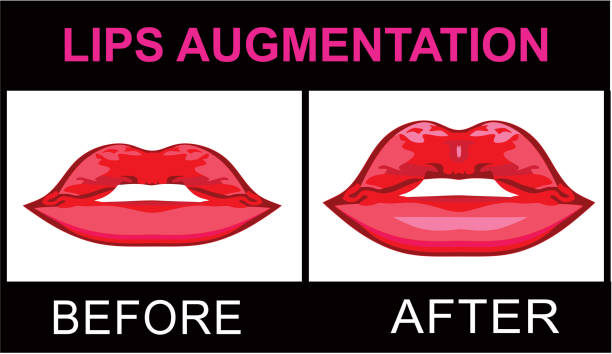 Lips Augmentation before and after vector art illustration