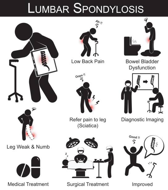 ilustrações, clipart, desenhos animados e ícones de pictograma de sintomas espondilose lombar (baixa dor traseira, referem dor perna, dormência da perna e fraqueza, a disfunção da bexiga intestino) e médica, tratamento cirúrgico - lombar