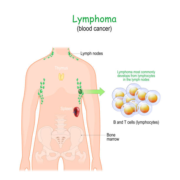lymphoma or blood cancer - 淋巴結 插圖 幅插畫檔、美工圖案、卡通及圖標