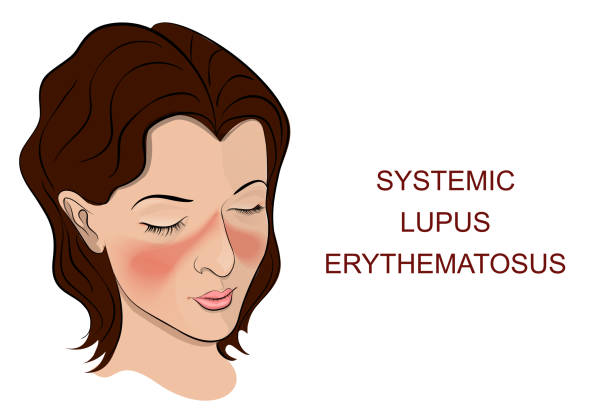 Meaning lupus What Is