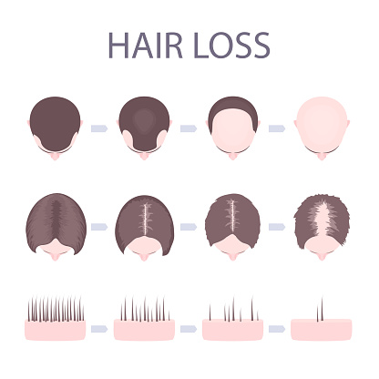 Male and female hair loss