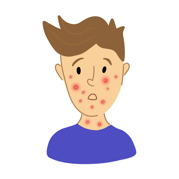 male suffering from new virus monkeypox. kid face sick with chickenpox pox virus infection. flat character portrait. red rash on face - symptoms of smallpox chickempox, monkeypox - monkeypox 幅插畫檔、美工圖案、卡通及圖標