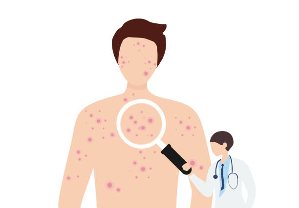 ilustrações de stock, clip art, desenhos animados e ícones de man suffering from new virus monkeypox infection on her face vector illustration. smallpox virus concept - varíola