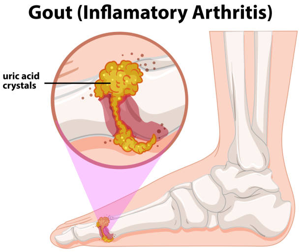 gout causes and symptoms
