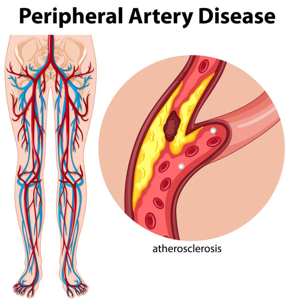 Medical peripheral artery disease Medical peripheral artery disease illustration illness stock illustrations