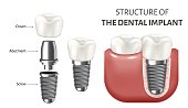 Medical vector illustration showing a structure of the dental implant. Realistic image isolated on white background. Poster depicting human teeth and dental implant parts. Screw, crown and abutment.